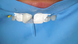 Matriçage dents antérieures - Dr Damien Savouré