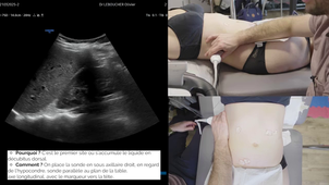 Épanchement Intra-Abdominal