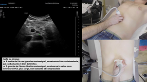 Échographie de l’Aorte Abdominale
